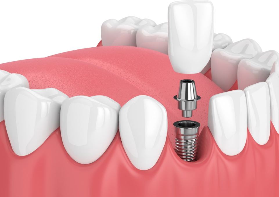 ایمپلنت دندان به چه صورت است؟