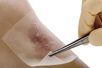 دستاورد| کاهش زمان بهبود زخم‌ها با زخم‌پوش‌های نانو